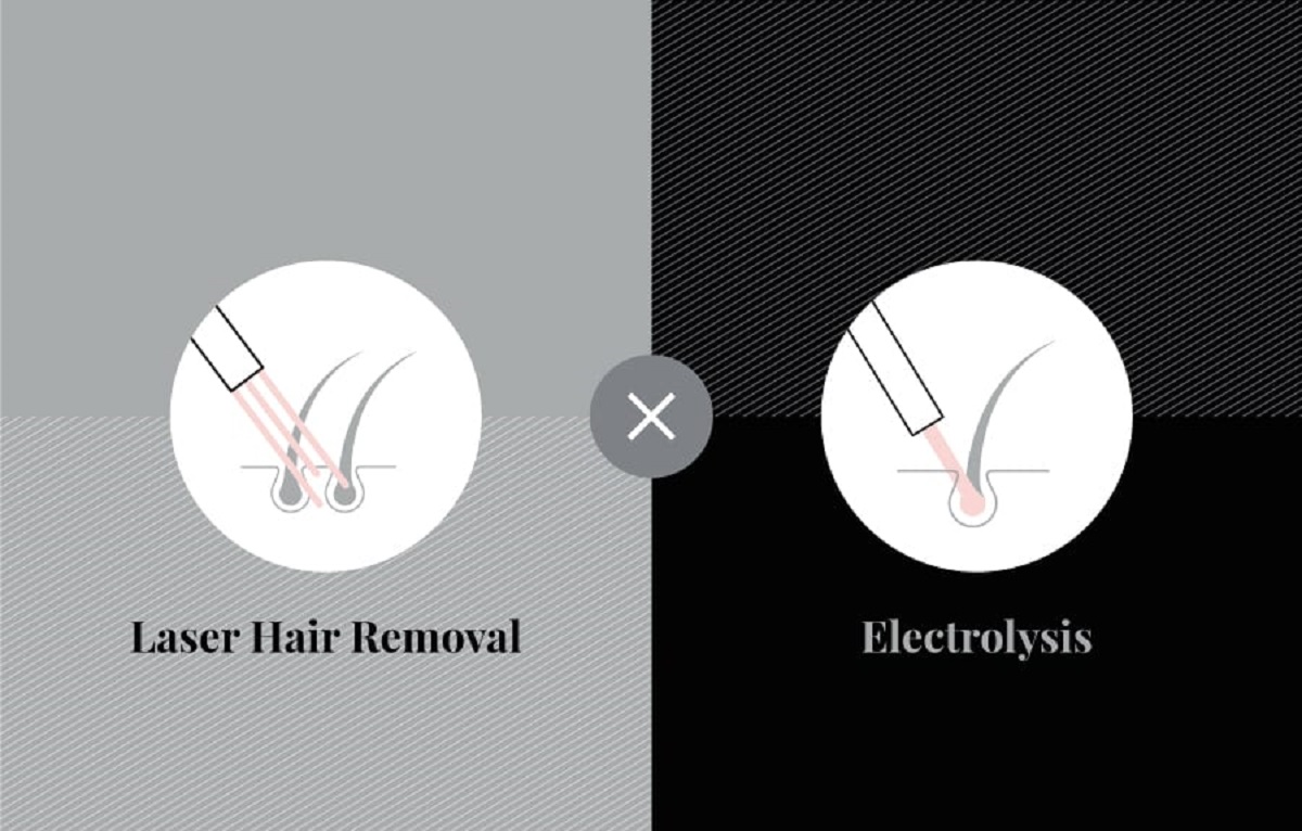 Laser Hair Removal Vs Electrolysis
